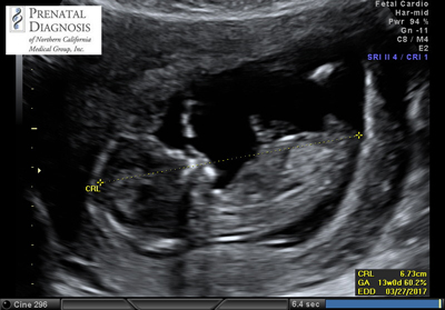 Ultrasound image of the 12-week-old fetus